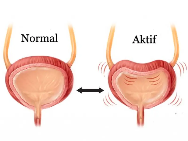 Aşırı Aktif Mesane