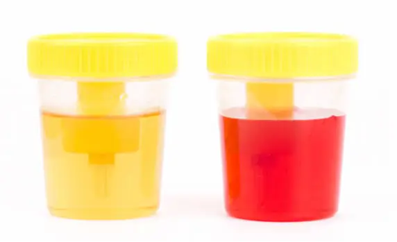 Hematuria