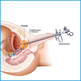 Kapalı Prostat Ameliyatı-TUR-P