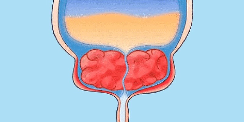 prostat-idrar-torbasi