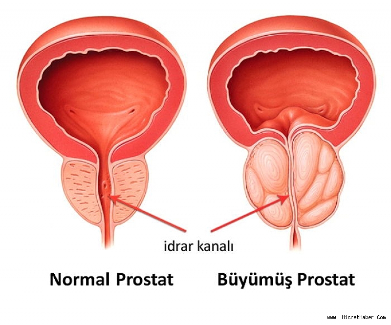prostat-sebepleri-nelerdir