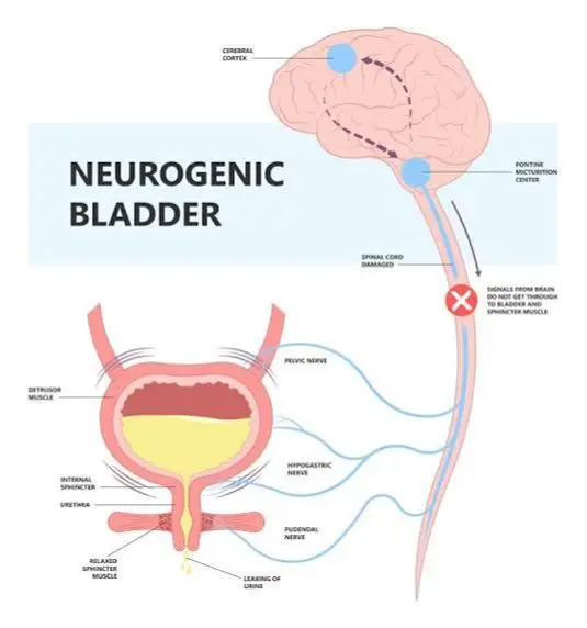 Neurogenic Bladder