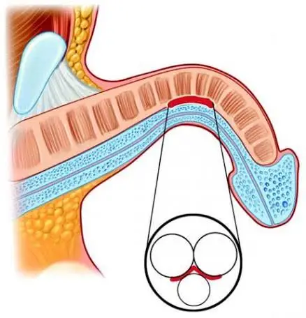 Peyronie