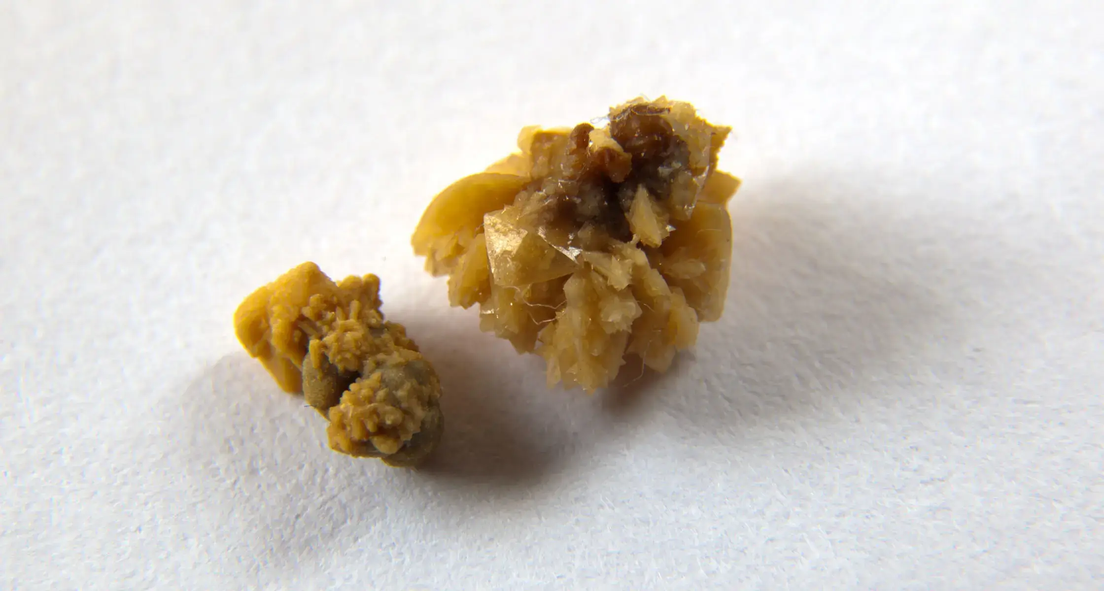 Stone Disease