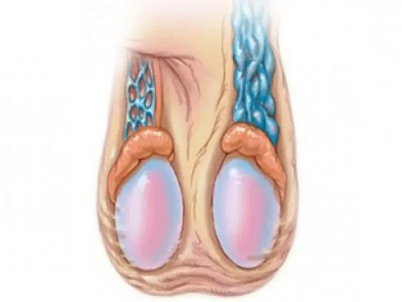 Testis Torsiyonu