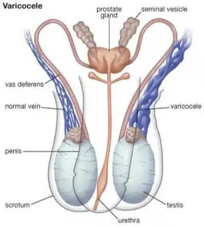 Varicocele